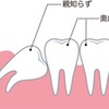 親知らずが痛くて歯医者に。