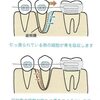 歯の矯正で、歯が動く仕組み