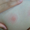 虫刺され、虫よけ