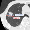 ・肺葉切除か、区域切除か・・・JCOG0802 / WJOG4607L