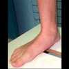 Are Fallen Arches Flat Feet?