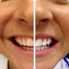 The Carbamide Peroxide Tooth Whitening