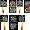 ギャンブル、たばこへの依存者が示す渇望に対する反応