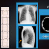 【　コラム-108：漏斗胸の心電図とは　】