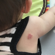 いちご状血管腫 カテゴリーの記事一覧 Yun Mom いちご状血管腫 カテゴリーの記事一覧 Yun Mom