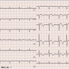 ECG-193：80才代女性、入院時心電図でした。