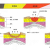 褥瘡の原因とメカニズム