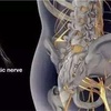 お尻の痛み、脚の痛み、実際には、坐骨神経痛、痛みを和らげるために3ストロークを学ぶ