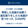 再発した虫歯の治療③　歯石取りをしたら虫歯が見つかった【2300円】