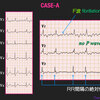 ECG-383： answer  #心電図検定試験-Q-8 Afibはどれか