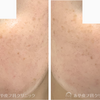色々な美容施術でも消えない顔のシミ、ADMかも知れません⚡️