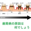 歯周病の原因は何でしょう