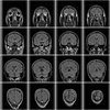 【ピルの副作用で脳出血１１】退院後初の検診。順調な回復を感じることができました！