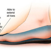 What Causes Bunions?