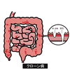 クローン病に関する雑学！