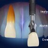 Giá trồng răng implant nha khoa