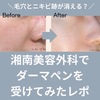 【経過レポ】効果は？湘南美容外科でダーマペンを受けてみた感想。口コミ