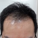 韓国で自毛植毛　FUE2000株　40代関西より
