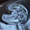 (20週1日) 妊婦健診4回目＠慈恵医大【妊娠６か月】胎児スクリーニング