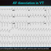 ECG-366：VTにおける、美しい房室解離波形を知りましょう= 心電図検定試験：傾向と対策 Q.013=