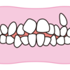 歯並びの悪さと歯周病