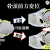 上腕骨頭前方偏位の影響とメカニズム