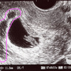 残業中に大出血…絨毛膜下血腫のこと（第一子妊娠時）
