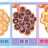 間質性肺炎