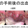 扁桃腺の手術