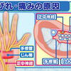 手根管症候群