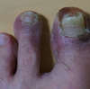  汗疱状湿疹（足の指のその後１）