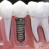 Làm sao biết bạn có nên trồng răng implant hay không?