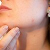 大人ニキビの予防に。食事や生活習慣の見直しで肌質を変える