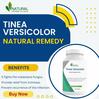 Natural Ways to Treat Tinea Versicolor Your Comprehensive Guide