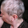 円形脱毛症の治療：2度目の受診