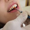 Regularly Asked Concerns Regarding Dental Veneers