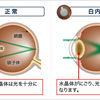 白内障について