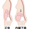 お腹ぽっこりの原因：内臓下垂と骨盤後傾