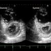 心エコー。肺高血圧症って何ですか？肺高血圧症。右心負荷。