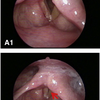 症例100：1週間前から嗄声と嚥下障害が出ている73歳女性（J Emerg Med. 2021 Jan;60(1):115-116.）