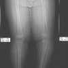 True Leg Length Discrepancy Testing