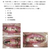 113回　義歯振り返り　治療用義歯編