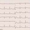 【コラム-021】正常心電図05＝(18誘導+1 &amp; Cabrera誘導)：43才女性。