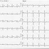 ECG-102：46才男性です。ぱっとしない胸部不快発作です。