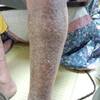 原因不明の皮膚炎がヒマシ油の塗布で治癒！（2014年4月27日）