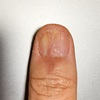 グロームス腫瘍摘出手術：術後320日目。爪にコーティング剤を塗る前と塗った後