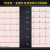 【ECG-306】70才代男性。CRBBB なんです。