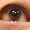 メタボじいさん 〜 「目が赤い」のは結膜下出血❗️