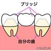 歯2本抜かれちゃいましたぁ・・・