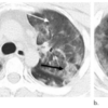 SARS-CoV-2感染症21例のCT画像所見の検討